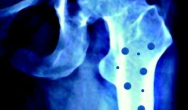 Pregledi širom Istre: osteoporoza sve prisutnija