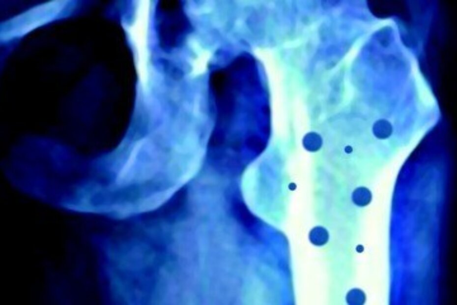 Osteoporoza