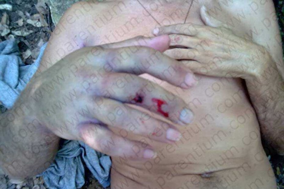 Mjesto ugriza na desnoj ruci Ukrajinca