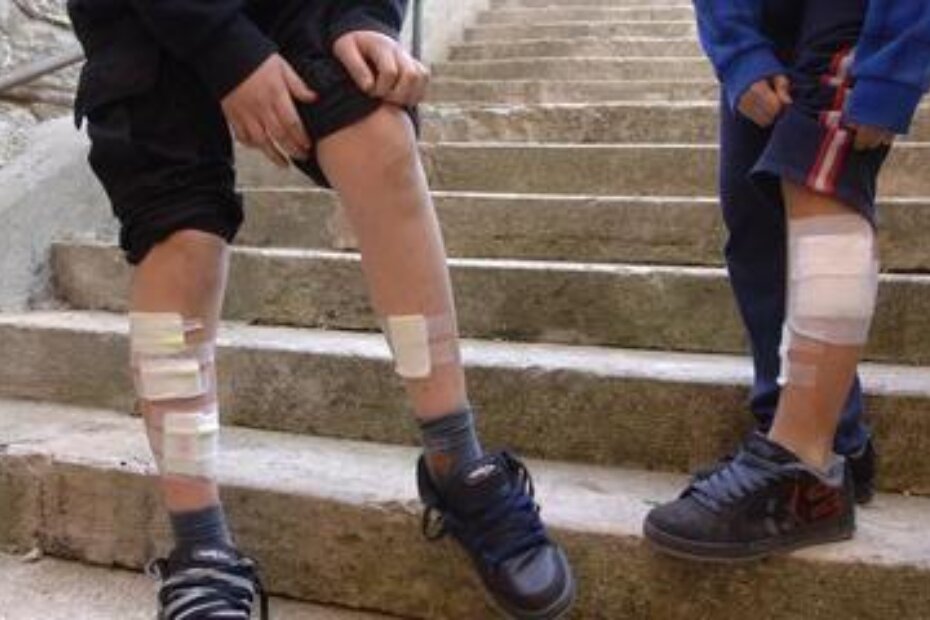 Dječaci pokazuju rane nastale "u napadu" (Foto: Glas Istre)