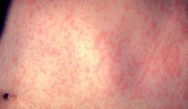 U 2021. godini novi pad broja cijepljene djece. HZJZ-ov epidemiolog Kaić: 'To otvara mogućnost za novu epidemiju ospica'
